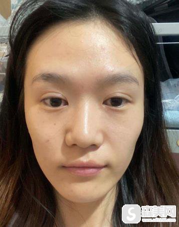 欧洲之星fotona售价贵不贵?上海九院恢复记录