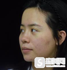 北京八大处欧洲之星4d做一次多少钱?附真实案例对比照