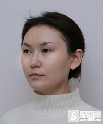 欧洲之星4d医生张国辉技术如何?恢复详情一览