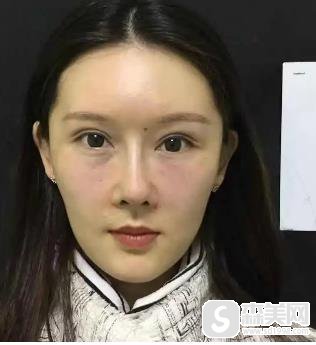 欧洲之星4d抗衰多久做一次？北京京民真是案例分享？