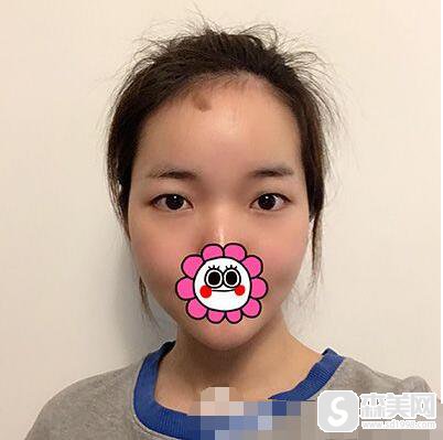 北京306医院做微创双眼皮怎么样,附微创双眼皮案例果图。