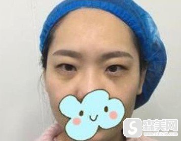 安医一附丁浩医生做双眼皮做的好么?附做双眼皮案例图