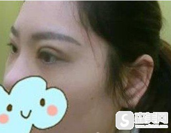 安医一附丁浩医生做双眼皮做的好么?附做双眼皮案例图