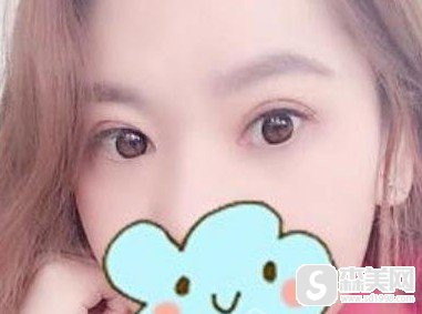 安医一附丁浩医生做双眼皮做的好么?附做双眼皮案例图