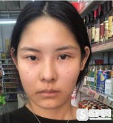 欧洲之星4d pro有烫伤吗?上海九院抗衰果图对比