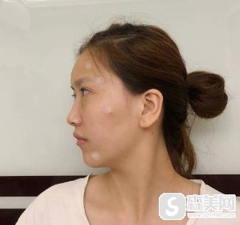 南宁303医院自体脂肪填充果？整形科术后恢复对比