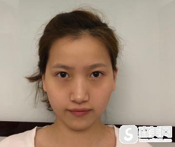 南宁303医院自体脂肪填充果？整形科术后恢复对比