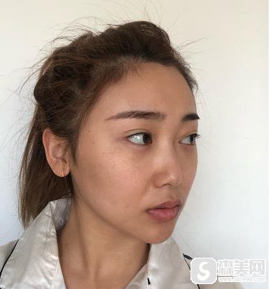 南京医科大学第二附属医院水光补水果？恢复果图对比