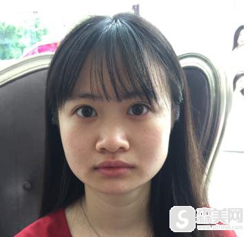 哪些人不适合打注射瘦脸？北京八大处恢复日记分享