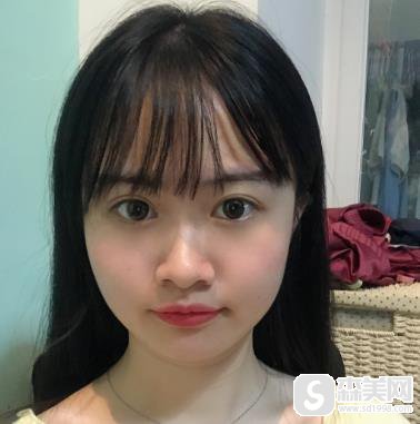 哪些人不适合打注射瘦脸？北京八大处恢复日记分享