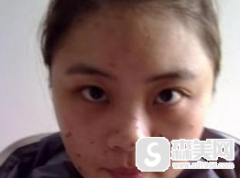 楚雄去痣的医院哪家好?楚雄现代整形的实力怎么样?