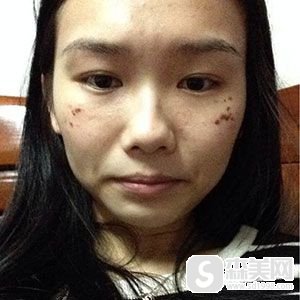 去痣的医院哪个比较好?北京中关村医院怎么样?