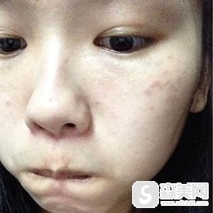 去痣的医院哪个比较好?北京中关村医院怎么样?