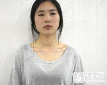 武汉华亚美容医院李爱林医生做的乳房整形手术怎么样?附果图