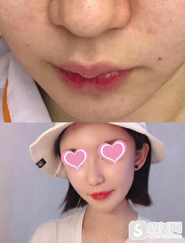 成都驻颜整形医院2021价目表,附鼻翼缩小的真实案例共享