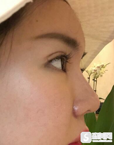 成都驻颜整形医院2021价目表,附鼻翼缩小的真实案例共享