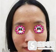 徐美琪医生的果酸焕肤果怎么样?真人案例分享