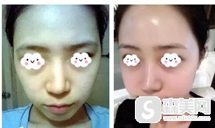 浏阳人民医院整形外科怎么样?该院进行的玻尿酸注射是真的吗?