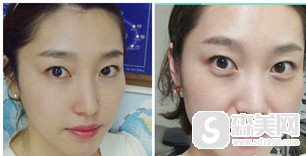 邵宏医生的技术怎么样?玻尿酸注射真的能去除法令纹吗?案例分享