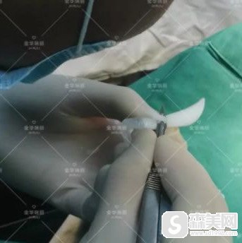 金华瑞丽整形美容医院怎么样?隆鼻技术好不好?案例分享