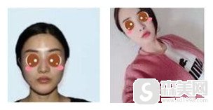 上海整形医生哪家好?李相雨医生能不能将颧骨高的问题进行化解?