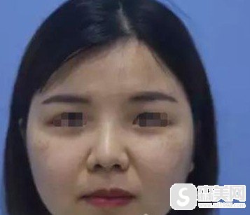 福州比华利整形医院林秋荣医生怎么样?附案例术后对比果图