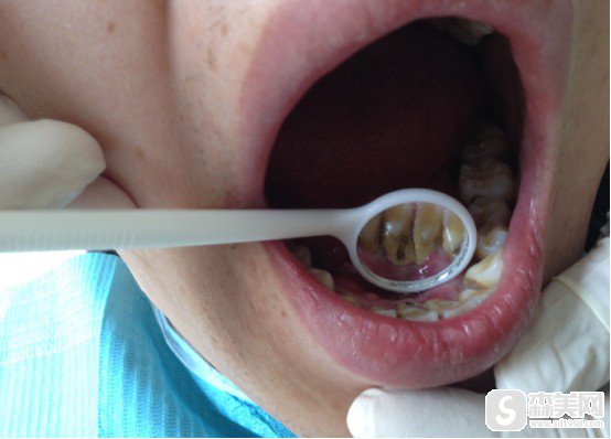 中国人民解放军第421医院刘春利医生牙周治疗果!医院信息