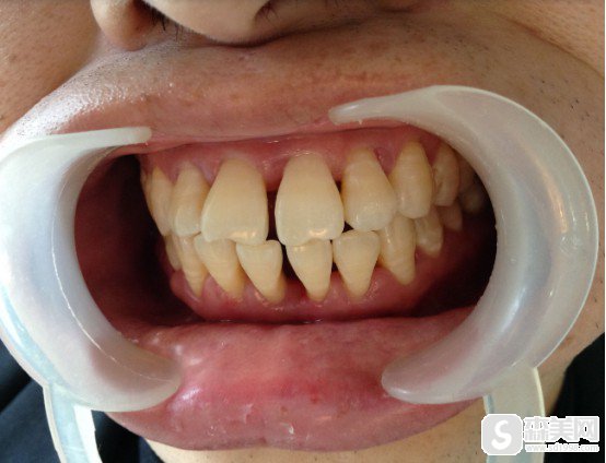 中国人民解放军第421医院刘春利医生牙周治疗果!医院信息