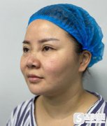医生肋软骨隆鼻技术怎么样？果图一览