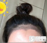 张宗雨医生的植发案例，发际线种植后的果怎么样?