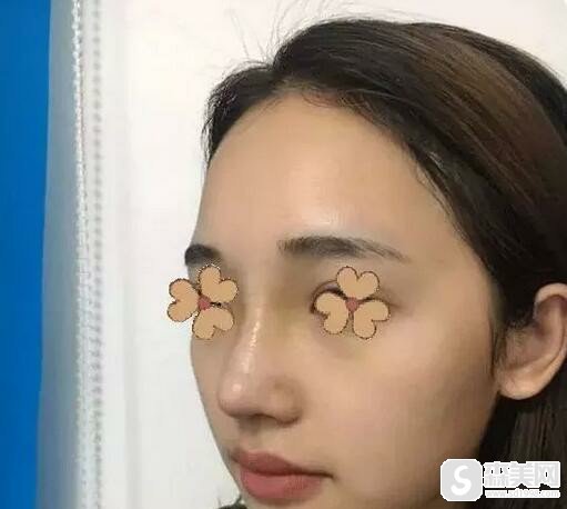 上海第九人民医院魏皎医生隆鼻做的好不好?医院信息,术后果怎么样!