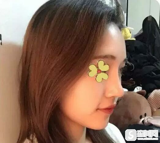 上海第九人民医院魏皎医生隆鼻做的好不好?医院信息,术后果怎么样!