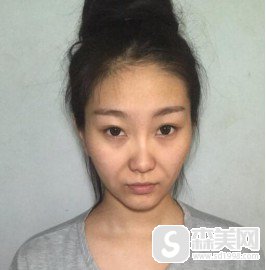 焦作蒙娜丽沙整形医院好不好?医生信息,面部填充术后果对比