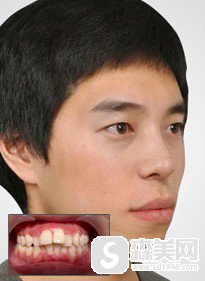 中国医科大学口腔医院卢利医生牙齿矫正术后果对比！医院信息