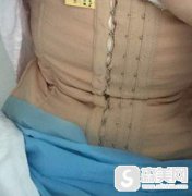 深圳阳光镭射溶脂案例?附前后对比图