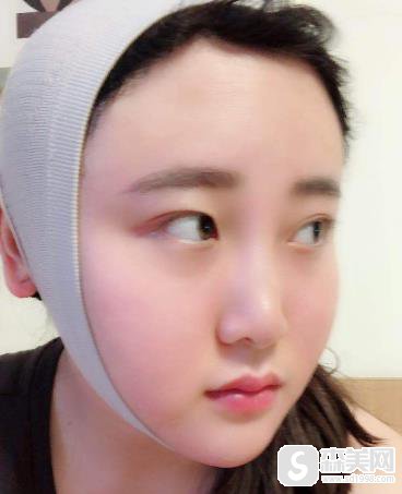 金一秀做的磨骨怎么样?前后对比图