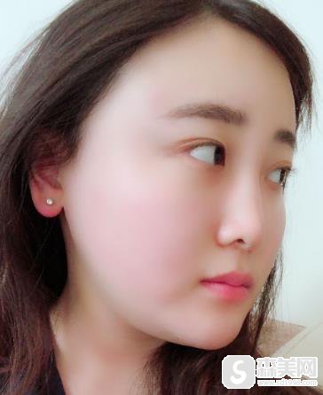 金一秀做的磨骨怎么样?前后对比图