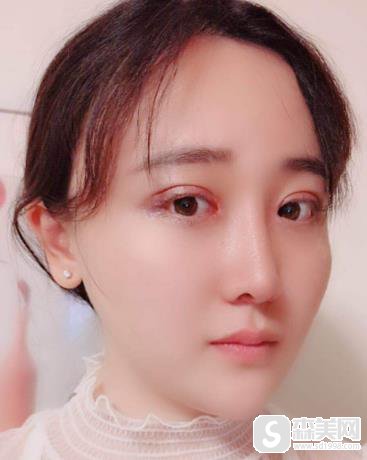 金一秀做的磨骨怎么样?前后对比图