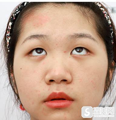 江苏省中医院整形科眼部果?附真实果图浏览