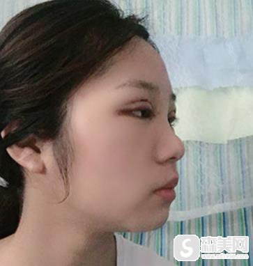 江苏省中医院整形科眼部果?附真实果图浏览