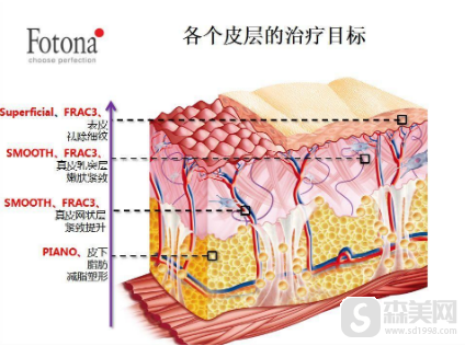 欧洲之星Fotona4D抗衰做一次可以看到果不？Fotona4D现在很火