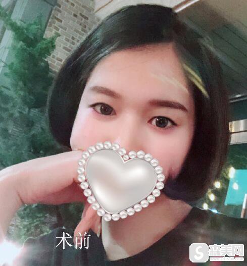 上海时光整形医院怎么样呢?医生信息,双眼皮术后果图浏览