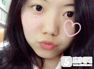 重庆华美整形美容医院口碑怎么样？医生信息, 附磨骨手术术后果图浏览