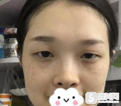 郑州大学第二附属医院整形科全切双眼皮案例分享!医生信息,术后果对比图