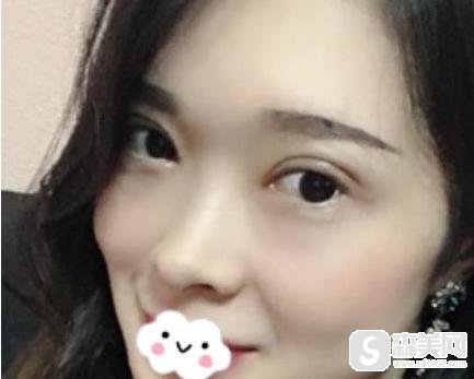 郑州大学第二附属医院整形科全切双眼皮案例分享!医生信息,术后果对比图