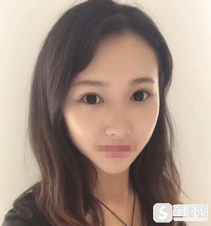 上海仁爱医院做双眼皮的手术后是什么样的！医生信息,附术后果对比图