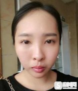 杭州三甲医院选择维多利亚，水光补水案例果图浏览