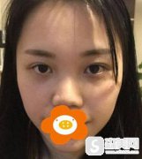 成都美莱L型硅胶垫鼻的果/真人案例展示