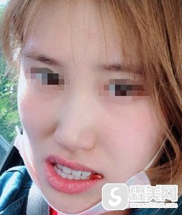 广州柏德口腔门诊部矫正牙齿多少钱?2021价格表曝光