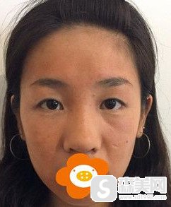 徐陇豫医生翘睫双眼皮加膨体隆鼻案例分享/面部改变到底有多么的突出?